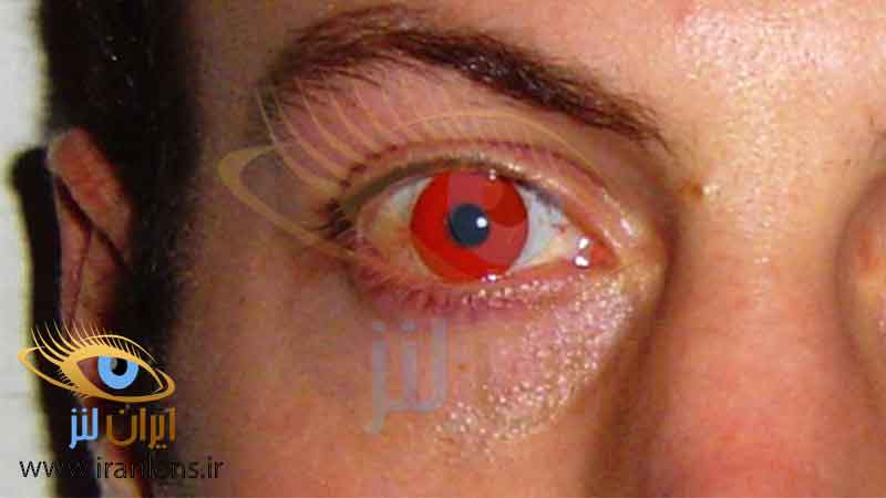 موارد منع مصرف لنز برای افرادی که آلرژی دارند
