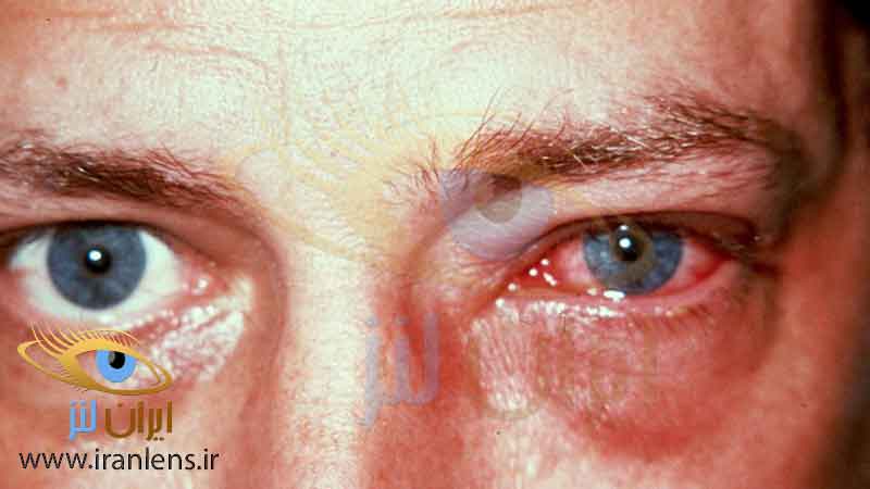 موارد منع مصرف لنز