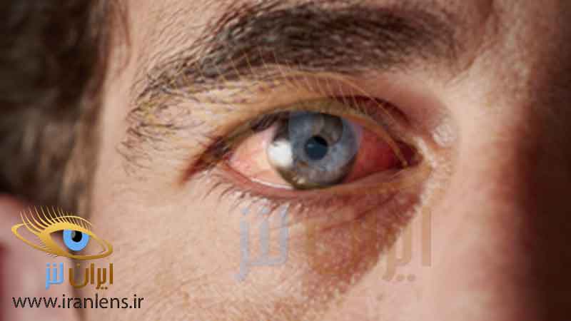 معایب استفاده مکرر از لنز چشم و موارد منع مصرف لنز