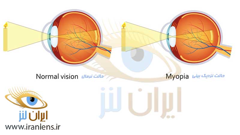 اختلال نزدیک بینی و درمان آن با لنز فصلی و لنز سالانه