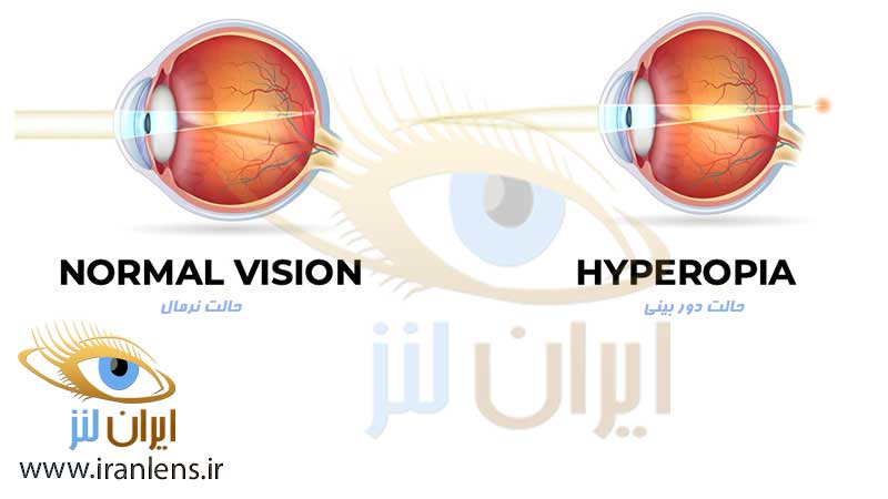 اختلال دوربینی و درمان آن با لنز فصلی و لنز سالانه