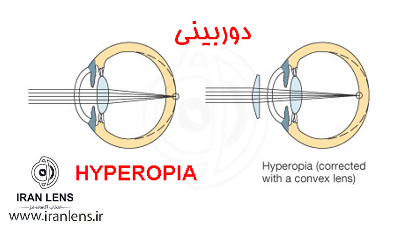 چرا به دوربینی مبتلا می شویم