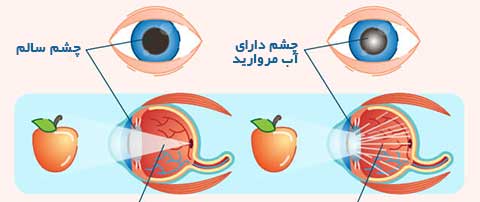 لنز داخل چشمی آب مروارید IOL