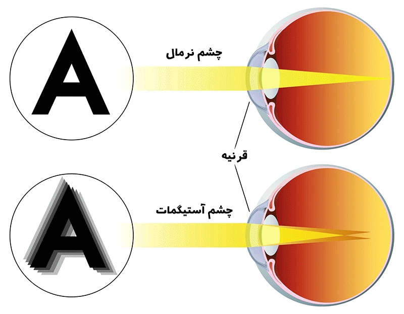 تفاوت قرنیه چشم سالم با چشم دارای آستیگمات